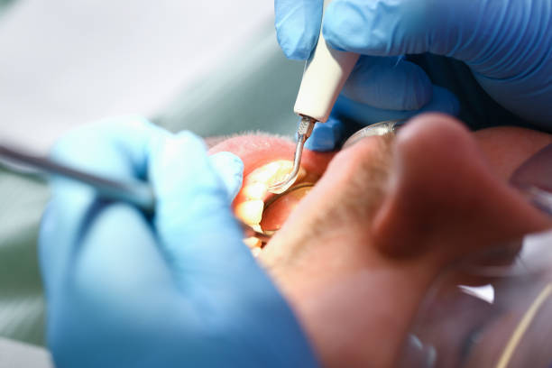 Best Emergency Dental Care for Sports Injuries in Appalachia, VA