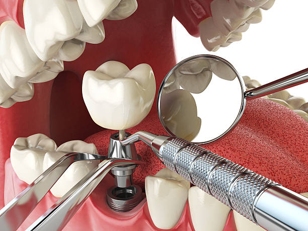 Best Emergency Cosmetic Dentistry (e.g., broken veneers) in Appalachia, VA